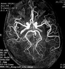 Depois da trombectomia: lítico intra‑arterial pode ajudar quando a macroartéria já abriu?